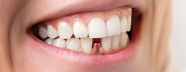 Prótesis dental