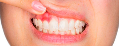 Infección dental